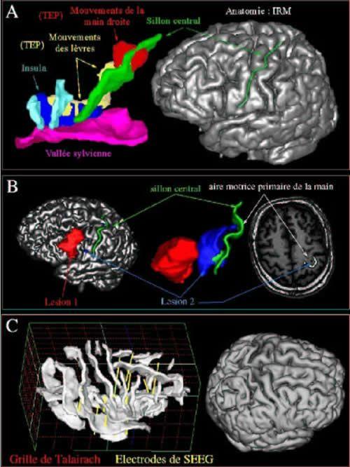 Connectivite Du Cerveau Techniques D Imagerie De La Carte Cerebrale